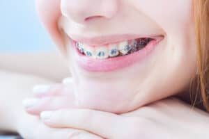 Orthodontics & Braces