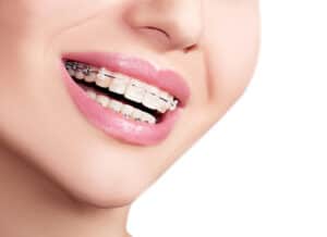 Orthodontics and Braces