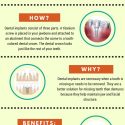 Dental Implants | Houston Dentistry