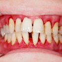 Baytown gum disease treatment