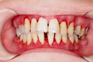 Baytown gum disease treatment