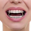 woman wearing braces - East Houston dentist