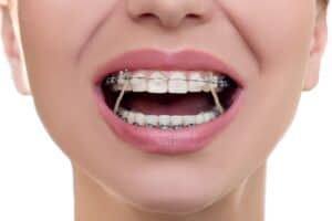 woman wearing braces - East Houston dentist
