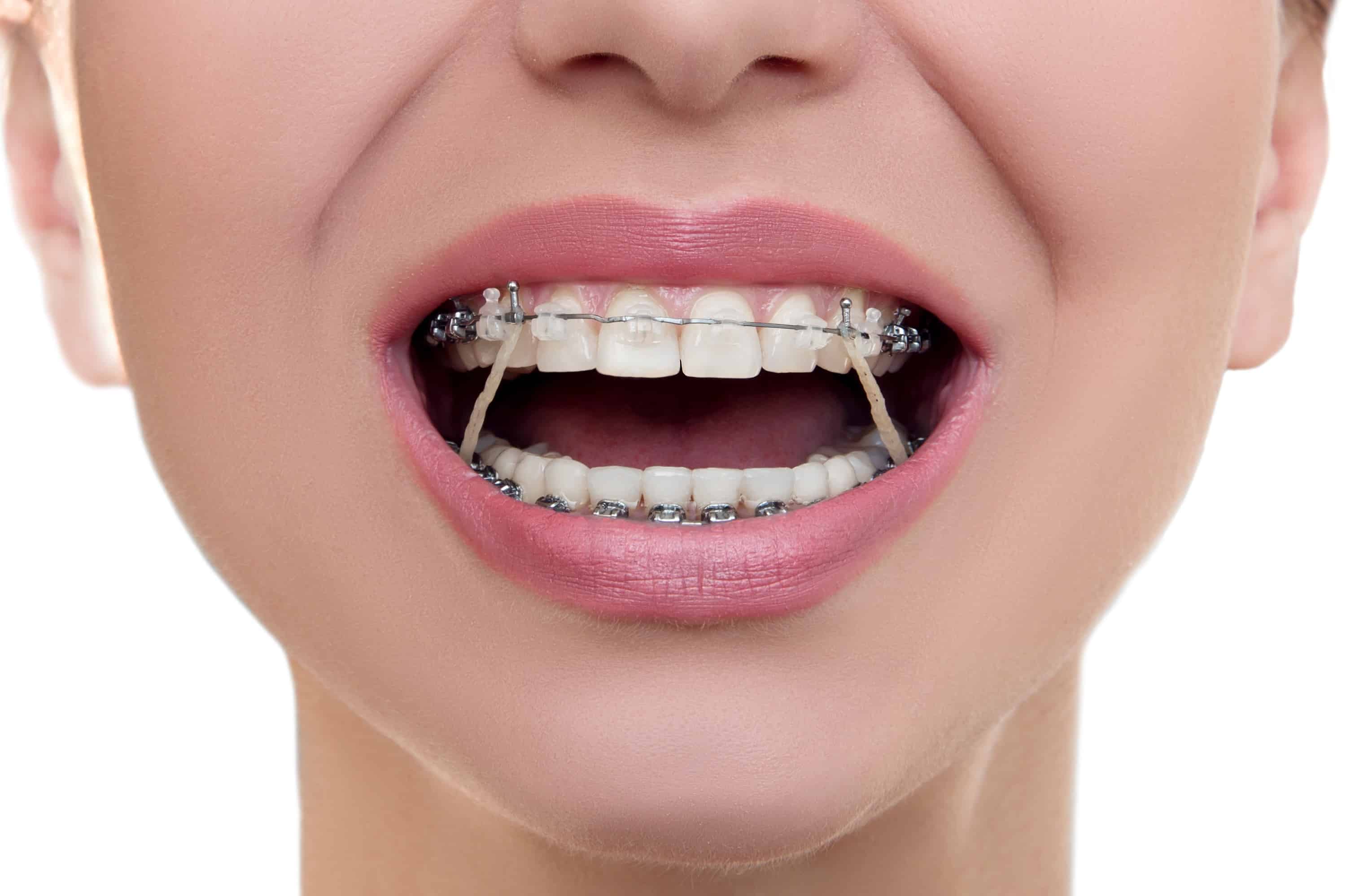 How Long Will I Need To Wear Braces | East Houston | Baytown