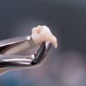 wisdom tooth extraction - East Houston dentist