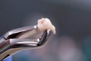wisdom tooth extraction - East Houston dentist