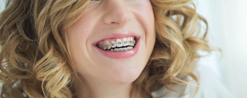 5 Reasons to Consider Getting Braces as an Adult