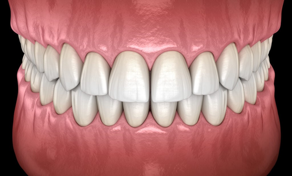 diagram of a Class 1 bite (normal, balanced bite)