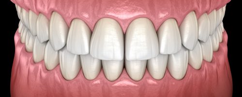 How Does My Bite Classification Impact My Orthodontic Treatment?
