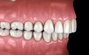 diagram of a Class II bite (overbite)